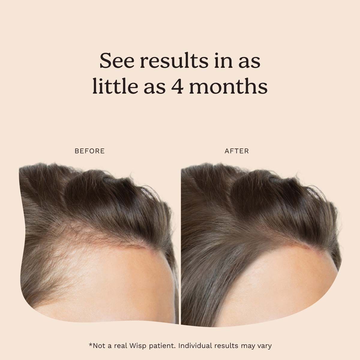 A before and after comparison of hair growth with a cream background