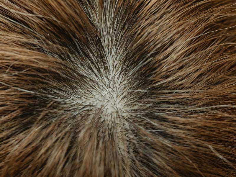 The top of a person's head showing an area of hair thinning