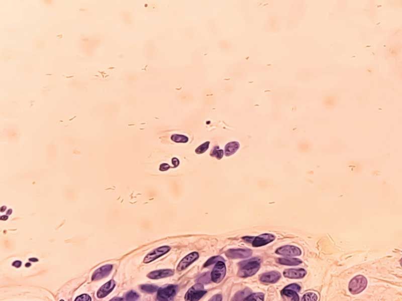 Microscopic pathology of fungus and bacteria for vaginal health treatment