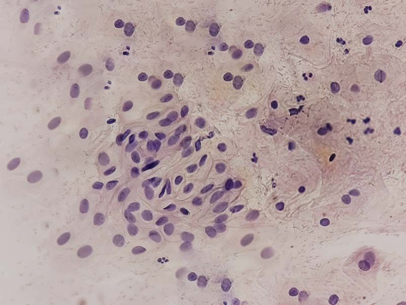 Pathology of a vaginal infection under a microscope